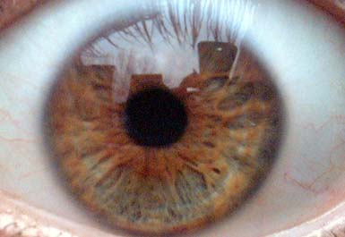 irisauge1